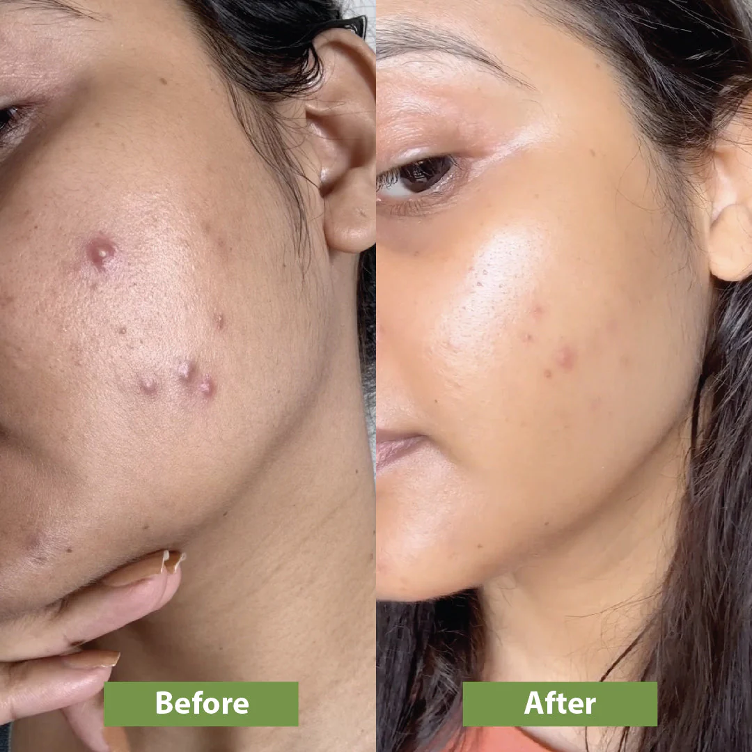 Anti-acne Kit - Image 5