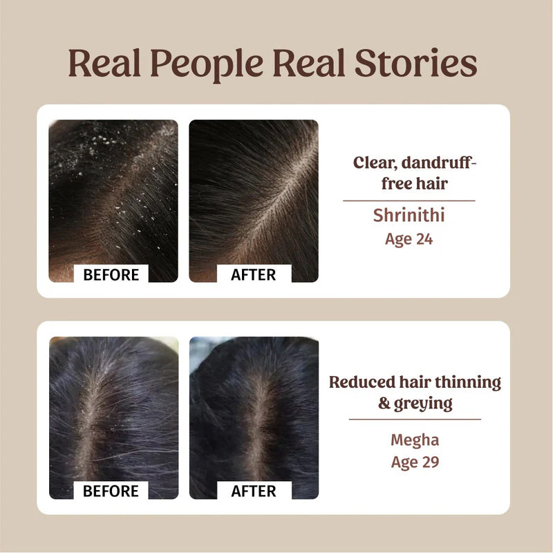 Anti-dandruff Kit - Image 4