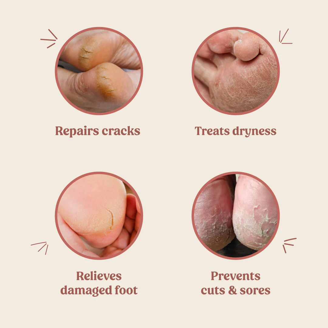 Foot Cream (Treats Cracked Heels) - Image 4